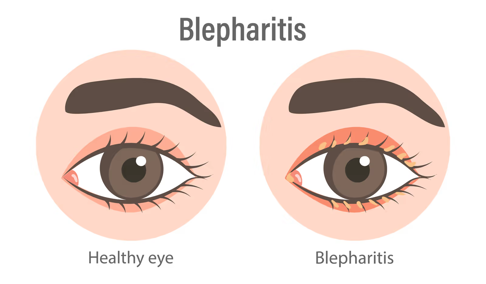 Comparação entre olho saudável e olho com blefarite, mostrando a margem palpebral inflamada.