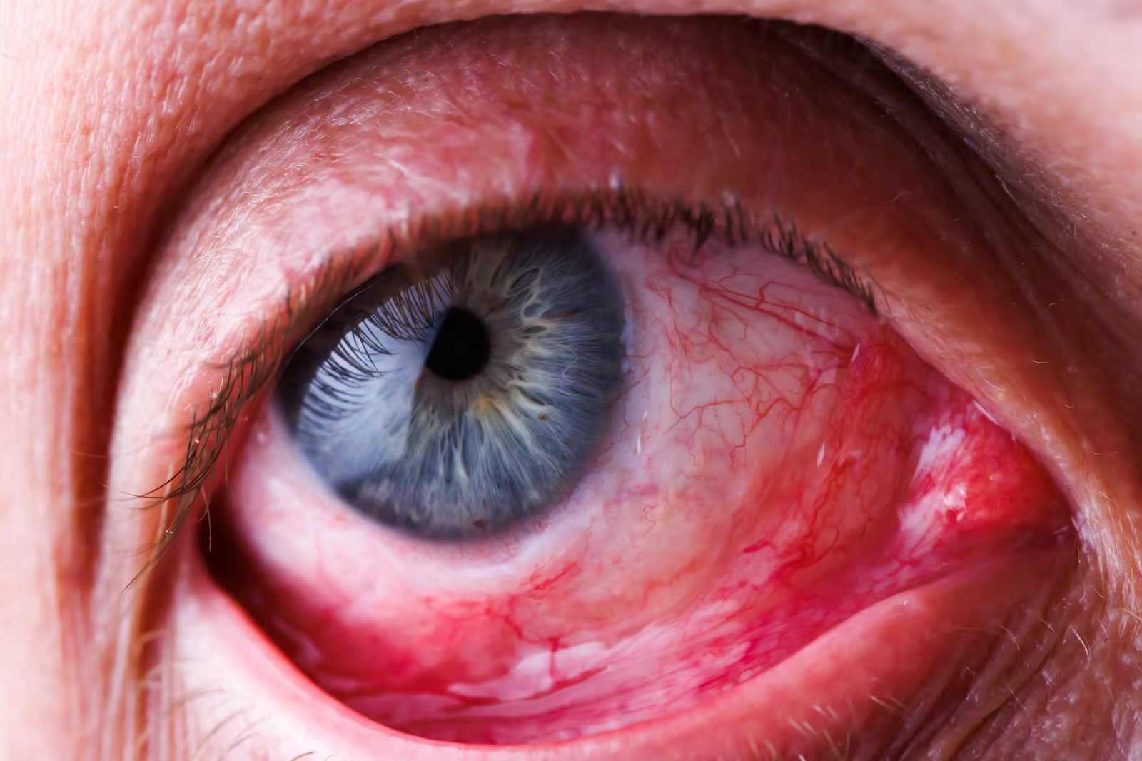 Olho com vermelhidão crônica e capilares dilatados na metade inferior, padrão típico de inflamação por doença palpebral.