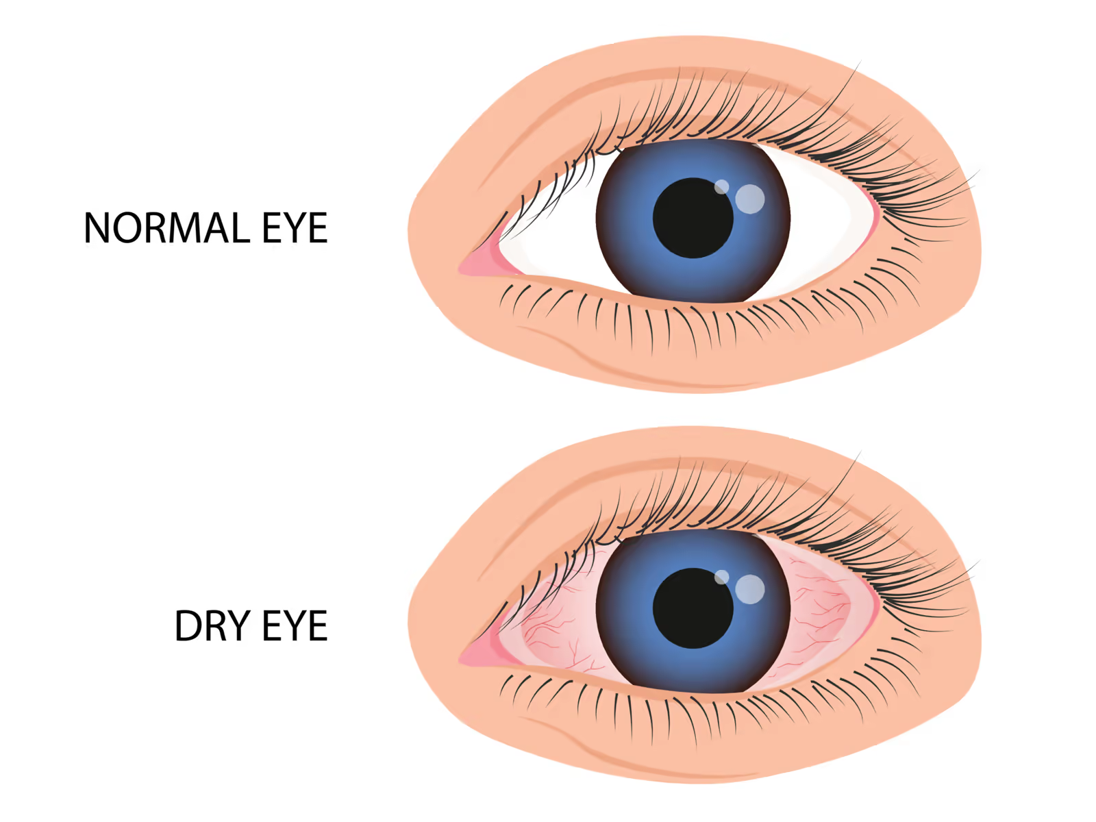 Comparação entre olho saudável e quadros de olho seco, ceratite e alergia ocular.