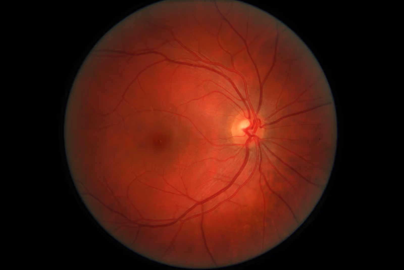 Retinografia mostrando o fundo do olho humano — retina, mácula, nervo óptico e vasos.
