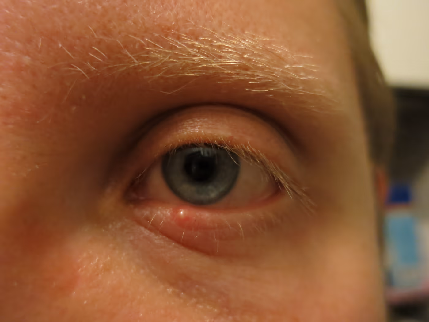 Pálpebra com terçol — pústula vermelha característica na borda dos cílios.