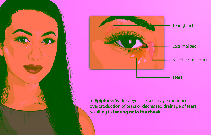 Esquema da epífora (olho lacrimejante): a ilustração identifica a glândula lacrimal, o saco lacrimal, o ducto nasolacrimal e as lágrimas que escorrem pela face quando há produção excessiva ou drenagem deficiente do sistema lacrimal. Fonte: MyUpchar via Wikimedia Commons, CC BY-SA 4.0.