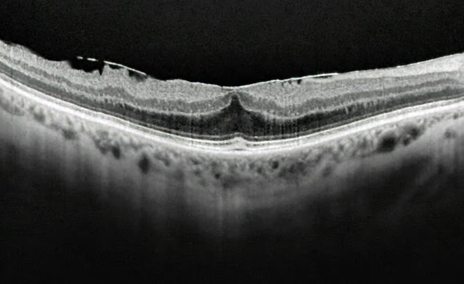 Membrana epirretiniana