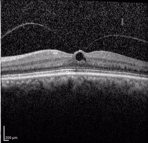 OCT de buraco macular pequeno no olho esquerdo. OCT de buraco macular pequeno no olho esquerdo.
