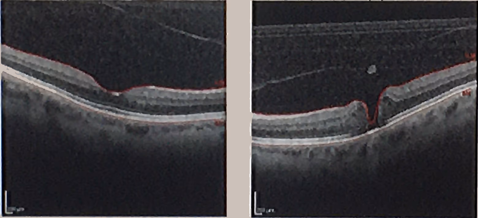 Cirurgia de buraco de mácula