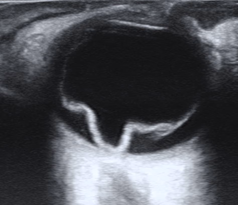 Ultrassom B-scan mostrando retina descolada como membrana flutuante.