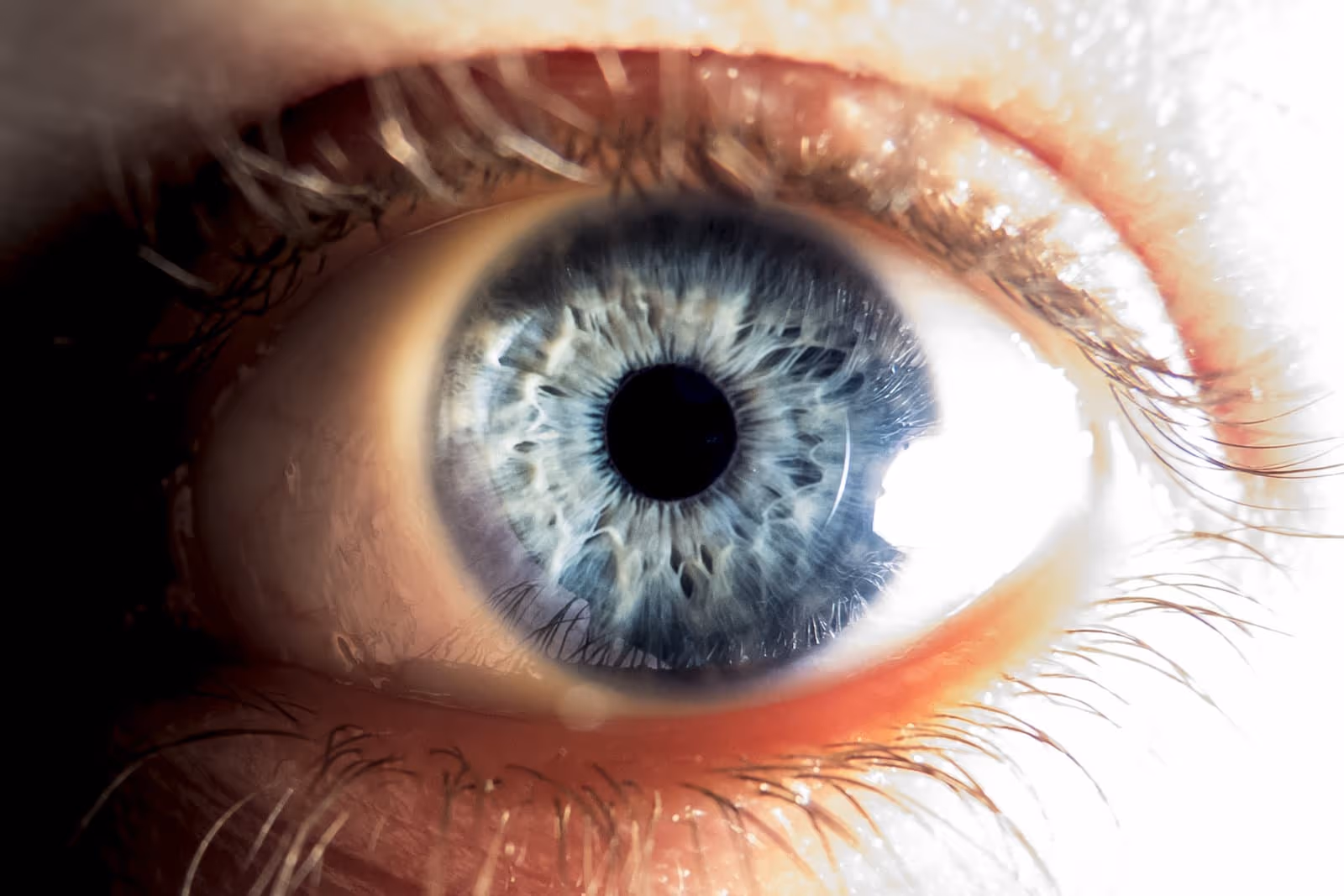 Close-up de um olho azul saudável após a cirurgia refrativa.