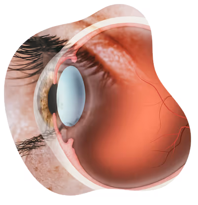 Ilustração da avaliação dos olhos antes do implante de lente fácica.