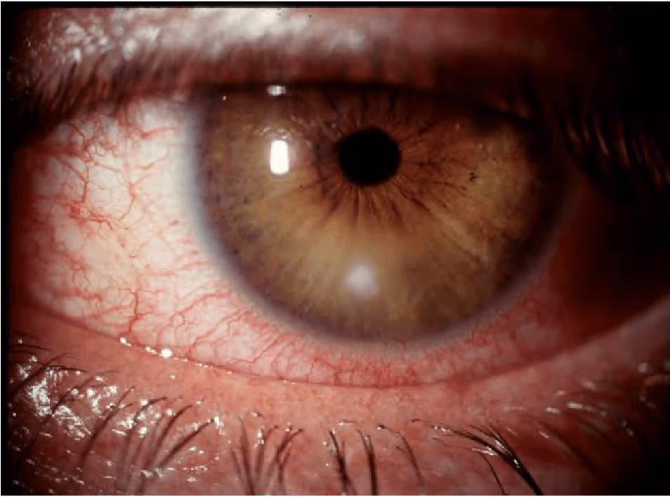 Úlcera de córnea por mau uso de lentes de contato. Note o ponto branco na córnea, além do olho vermelho e irritado.