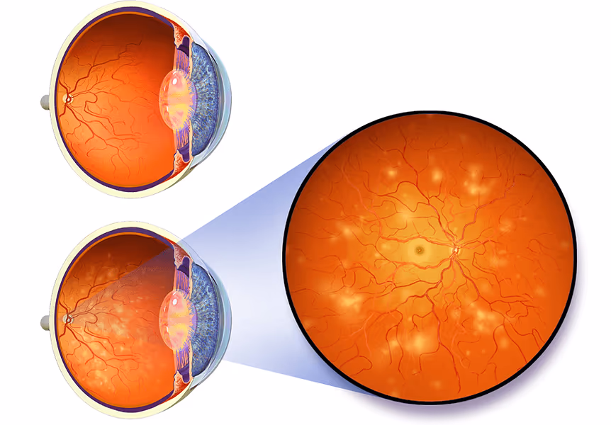 Foto mostrando sinais da retinopatia diabética como exsudatos algodonosos no fundo de olho.