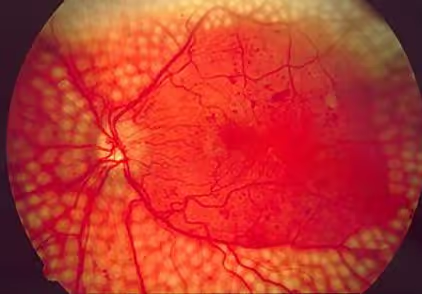 Foto mostrando fotocoagulação da retina para tratamento da retinopatia diabética.