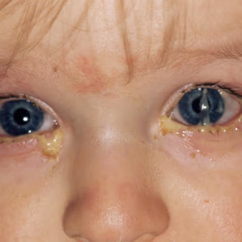 Criança com conjuntivite Bacteriana