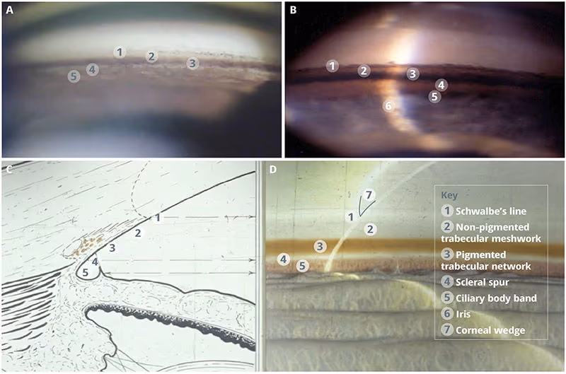 Exame mostrando o Ângulo do Olho (risco de Fechamento Angular e Glaucoma Agudo)