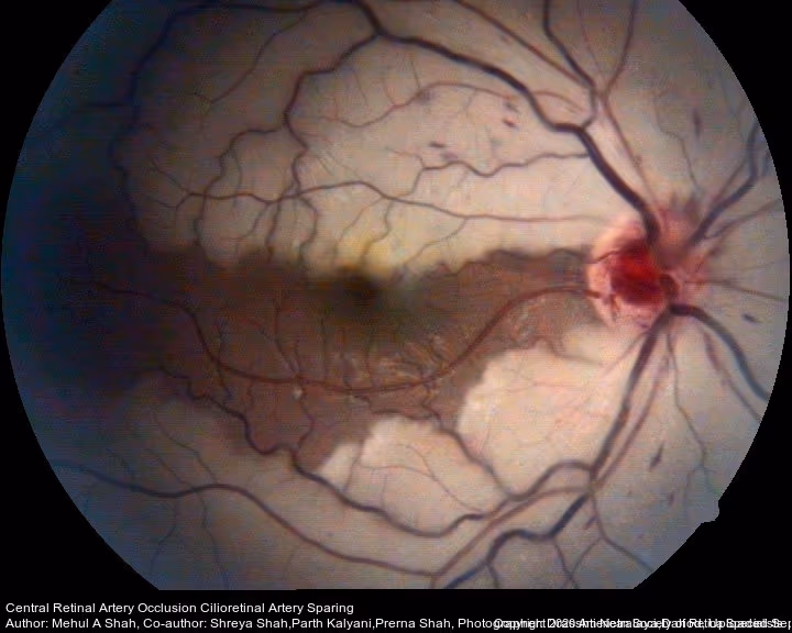 Oclusão da artéria central da retina, mostrando a retina pálida. Neste caso há circulação preservada da artéria ciliorretiniana, que nutre a mácula central.