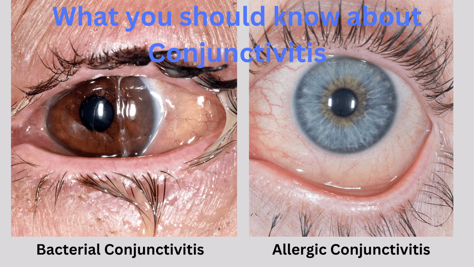 Conjuntivite Bacteriana versus a Conjuntivite Alérgica.
