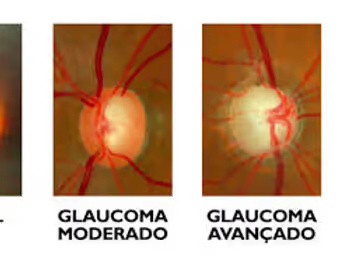 Imagem Mostrando Aumento de Escavação no Glaucoma