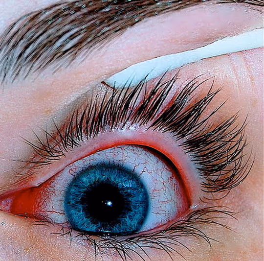 Olho humano com conjuntivite viral, nota-se a vermelhidão dos olhos.