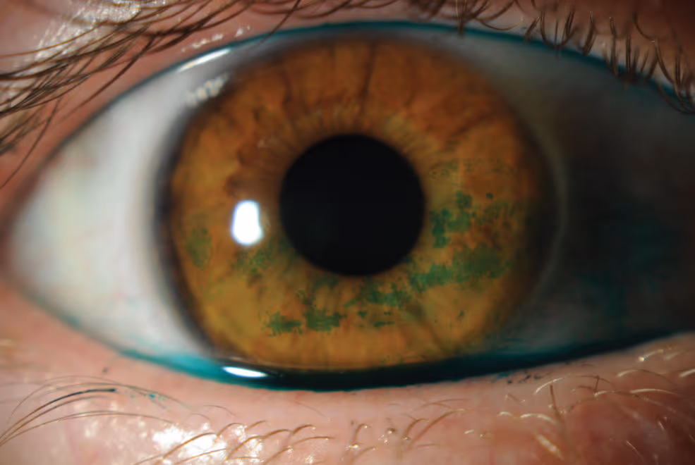 Teste com verde lissamina mostrando alterações da superfície ocular.