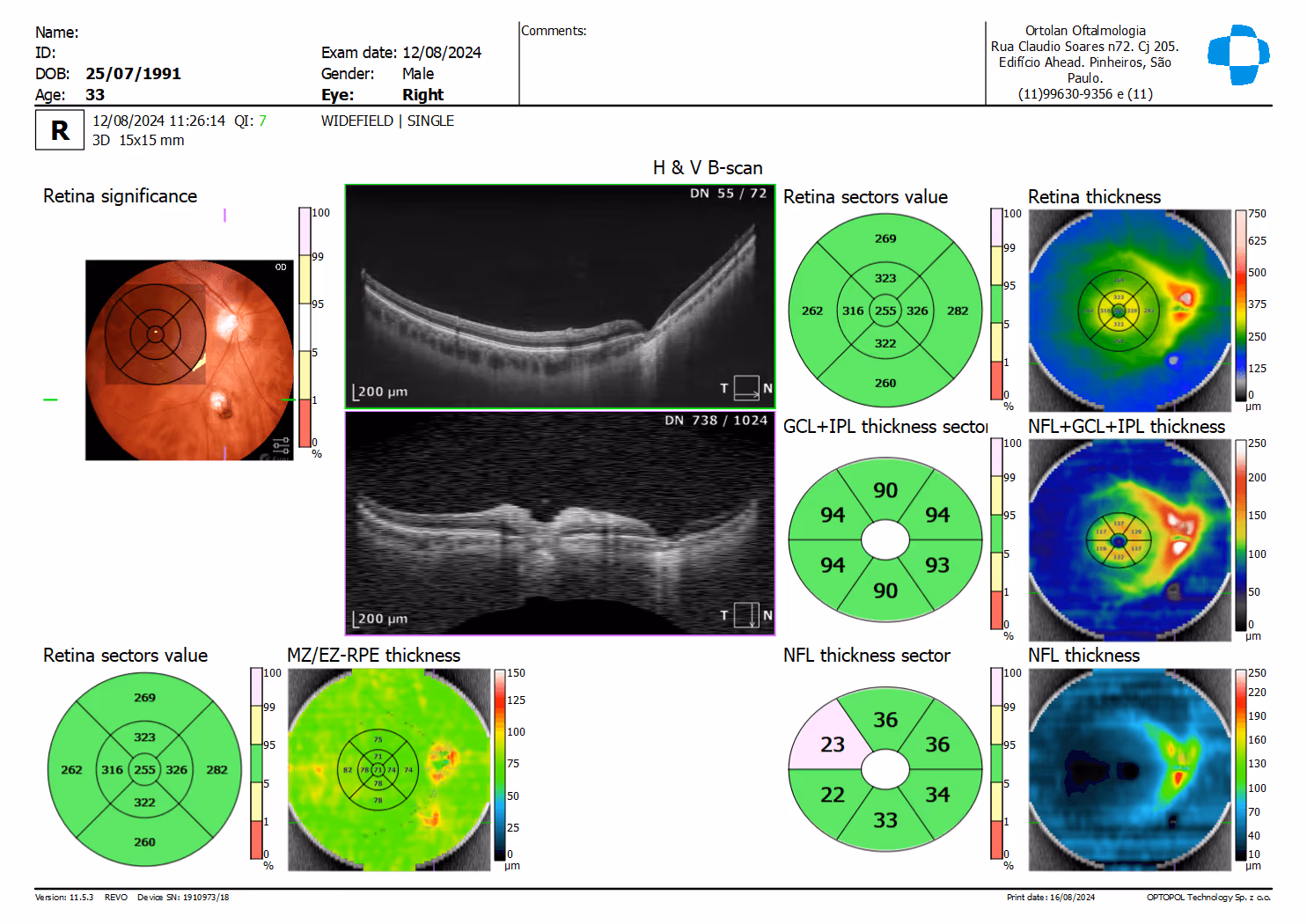 OCT correlaciona a Retinografia (foto de fundo de olho) que mostra uma atrofia corriorretiniana com o B-SCAN do OCT demonstrando atrofia total da retina e parte da coróide pontualmente.