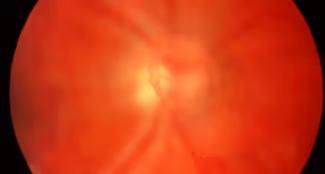 O descolamento do vítreo posterior é uma condição fisiológica que ocorre em pacientes com mais de 40-60 anos e pode estar associada ao descolamento de retina regmatogênico, ao aparecimento de moscas volantes e ao buraco de mácula.