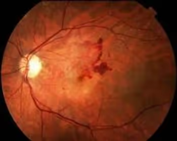 Pequenas hemorragias que ocorrem na retinopatia diabética e podem levar à perda de visão.