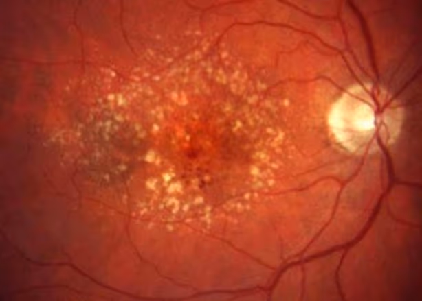 Retinografia de caso de Degeneração macular relacionada à idade, demonstrando as drusas na mácula.