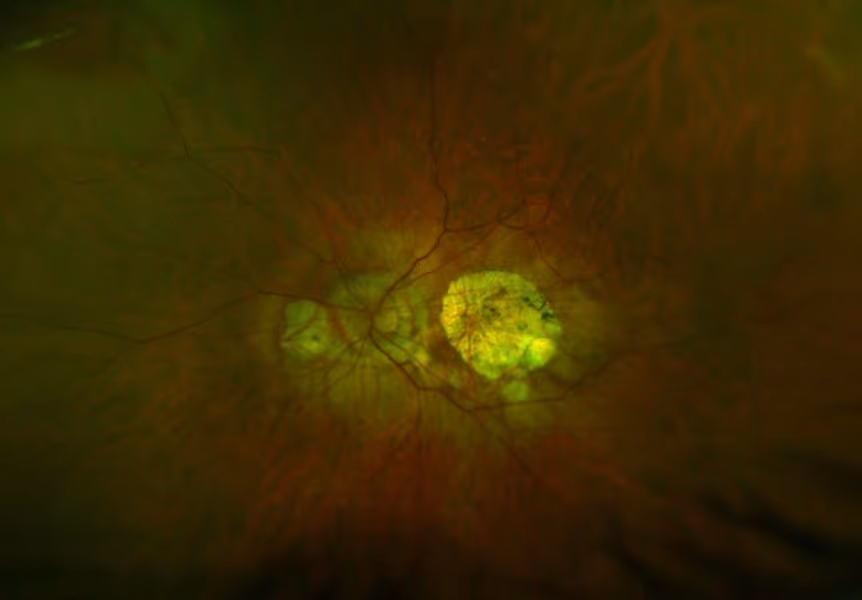 Foto de grande angular (widefield) de alta miopia degenerativa com maculopatia miópica associada, estafiloma posterior e degeneração peridiscal.