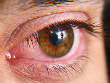 Caso de olho seco moderado com vermelhidão dos olhos.