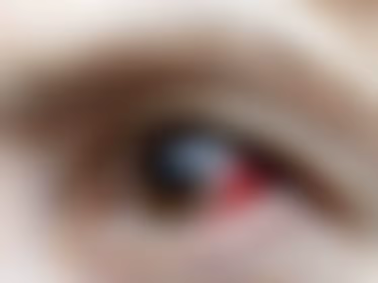 Trauma Ocular: Compreendendo os Riscos e Obtendo Atendimento Adequado