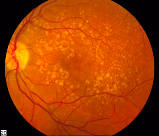Retinografia de fundo de olho mostrando DMRI intermediária.
