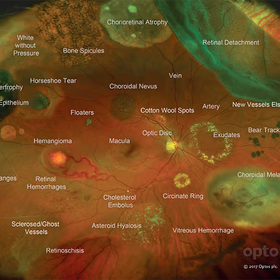 Atlas em imagem mostrando as doenças que podem ser diagnosticadas através do mapeamento de retina. Esta é uma retinografia de grande angular usada como ilustração — o mapeamento clínico em si não gera fotos.
