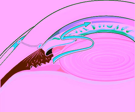 Ilustração do glaucoma de ângulo fechado — a íris bloqueia a drenagem do humor aquoso no ângulo iridocorneano, quadro tratado e prevenido pela iridotomia a laser YAG. Fonte: Smart-Servier via Wikimedia Commons (CC BY 3.0).