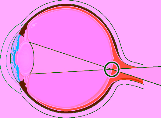 Astigmatismo