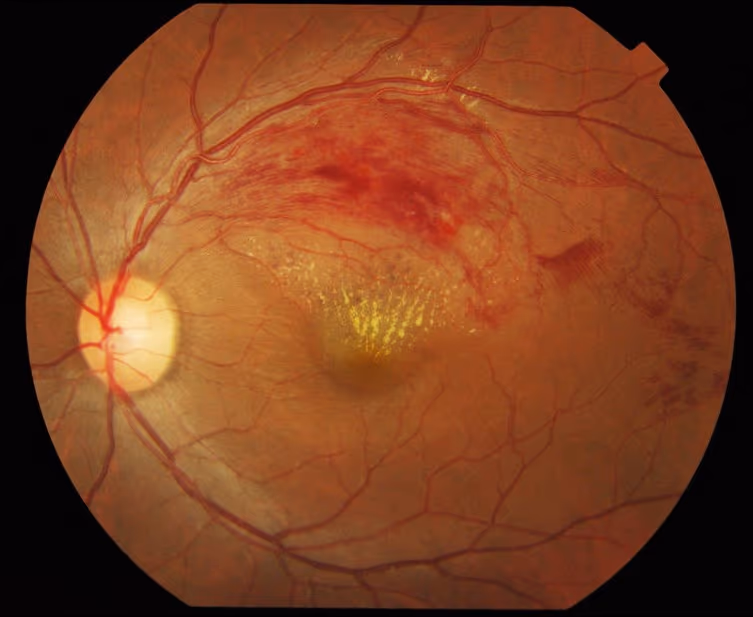 Retinografia mostrando hemorragias em oclusão de veia central da retina.