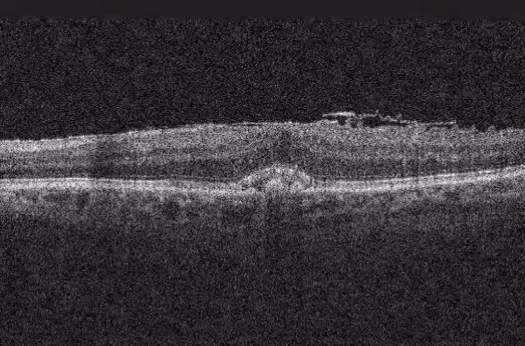 Tomografia de coerência óptica (OCT) mostrando membrana epirretiniana.