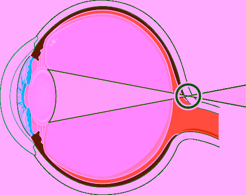 Hipermetropia