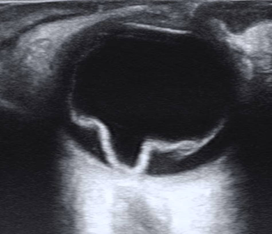 Retinografia ilustrando descolamento de retina.