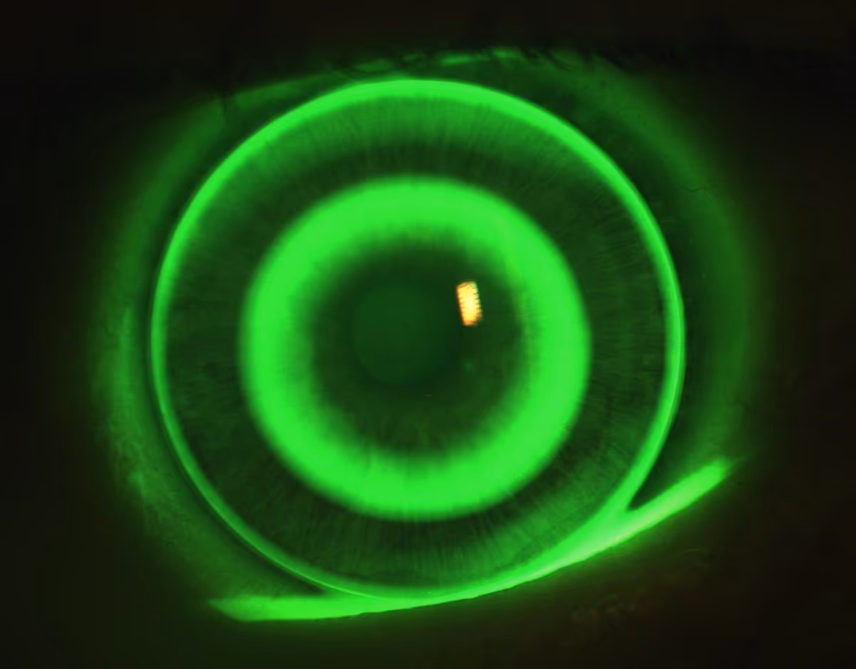 Imagem com fluoresceína mostrando o encaixe de uma lente rígida sobre a córnea.